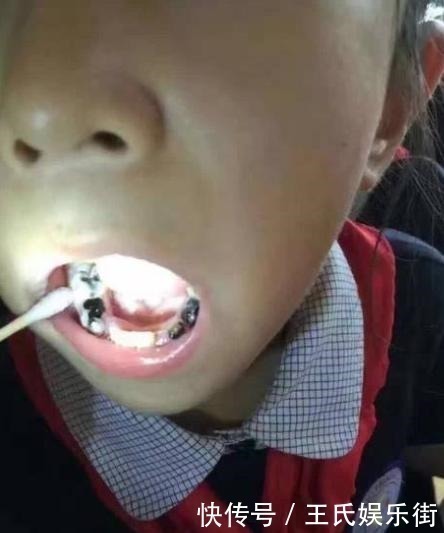 臭味|孩子被嘲笑“嘴太臭”,被同学孤立,医生取出小颗粒,宝妈都嫌臭