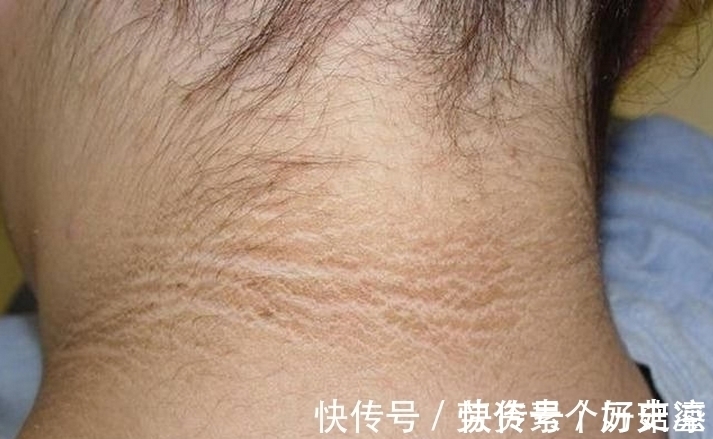 婷婷|6岁小女孩脖颈发黑洗不掉，去医院做检查，医生的话让妈妈笑了