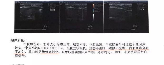 卵巢囊肿|结节、息肉、囊肿是癌症先兆吗?北肿专家们说出了真相!