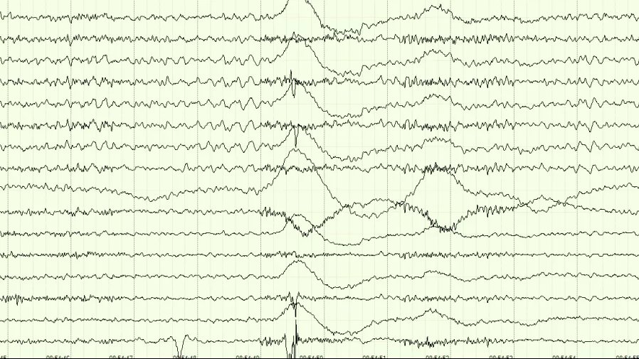 心跳骤停|医生,我爸还能醒吗?会不会变成植物人?