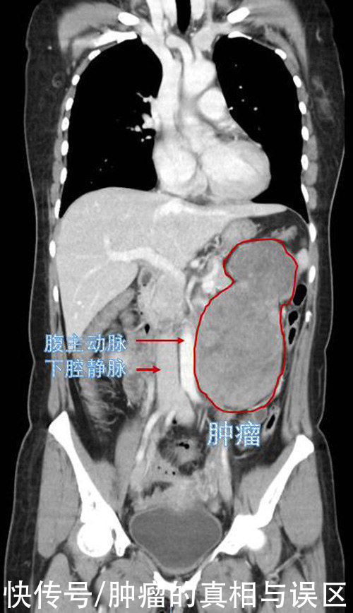 元凶|女子剧烈腹痛，“元凶”竟是腹内20cm大肿瘤，这个病例值得警惕