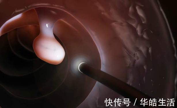 肠镜检查|有三种息肉最好及时切除,拖延太久就会变成恶性肿瘤!你清楚吗?