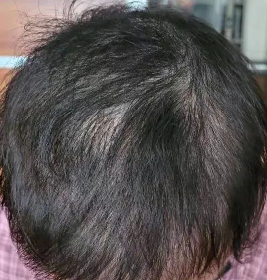 拔毛癖|杭州初二女孩发量越来越稀少！医生指导半年，控制住了……