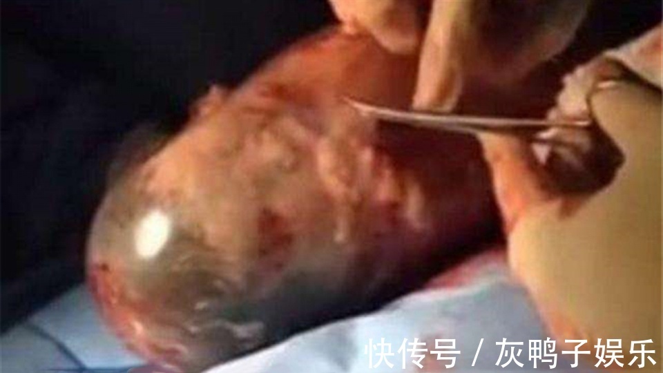 医生|生下“带壳宝宝”,产妇着急落泪,医生却高兴祝贺是好事