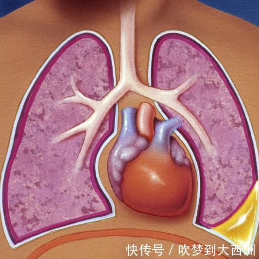 积液|一场流感可能引起心包积液,心包积液怎么治疗心包积液怎么护理