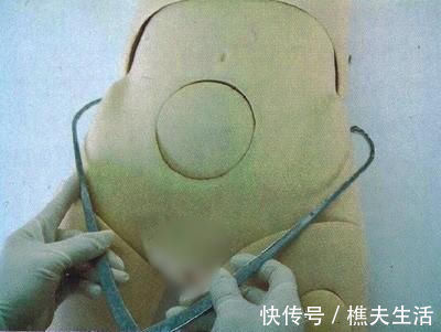 剖腹产|孕期“骨盆测量”一般什么时候做?提前了解,关乎能不能顺产生娃