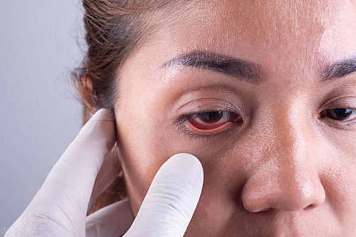 眼袋很大，做手术能够一劳永逸地解决吗？医生告知答案，值得收藏