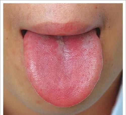 辩证|?一吃饭就胃胀?是因为“胃痞”!4类中成药辩证使用,对症治疗