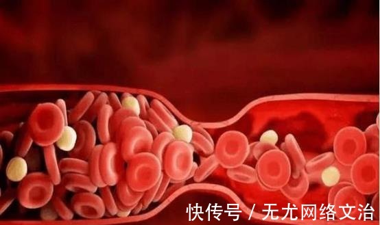 克星|高血脂“克星”公开，避免做这几件事，血管干净通畅