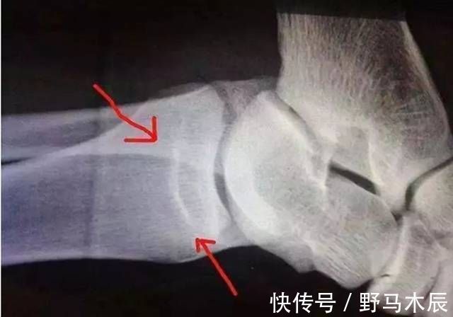 妙妙|孩子骨骺线闭合前,身体会释放提醒信号,此时抱佛脚还有长高希望