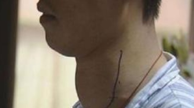 结节|三种发物,吃得越多,甲状腺结节越大医生提醒控制自己