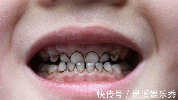小黑牙|3岁孩子满嘴”小黑牙“!医生怒斥:不是糖果,是家长太无知!