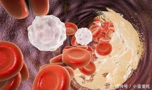 心血管|血管堵塞,身体会出现4种情况,再不注意,当心血管堵死了