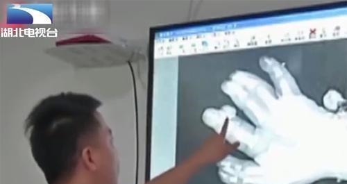 指头|罕见！新生儿有25根指头，一看到妈妈的手，医生瞬间明白了