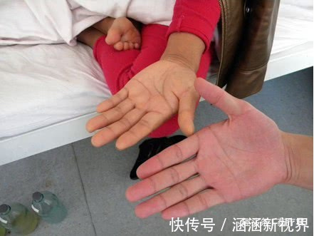 医生|患上尿毒症是吃出来的,医生忠告5种食物要少吃,肾会感激你