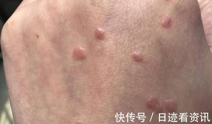 维c|吃一口等于一瓶维C,医生提醒HPV的人不妨多吃,远离宫颈癌