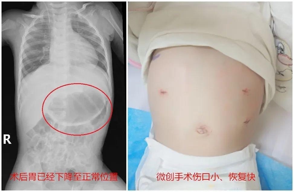 宇宇|广西1岁幼儿频繁呕吐,医院一检查,胃不见了!