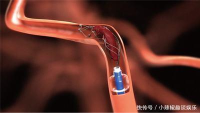 血管决定寿命长短,104岁老人血管年轻且不堵,原因竟是这3件事