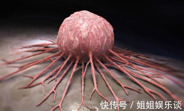 肿瘤|当乳房出现酒窝症状时,也许是癌症找上门了,你有此情况吗?