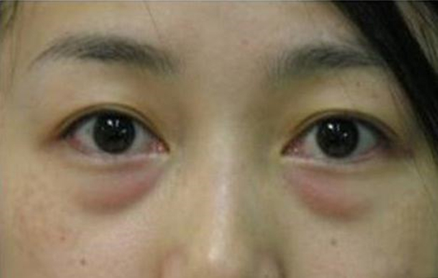 湿气|怎样祛眼袋中医还真有办法,支你3招,一招比一招强,女性要看