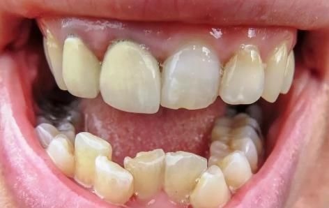 牙医|孩子换牙齿,新长的牙齿却是歪的,可能是家长这些没做好