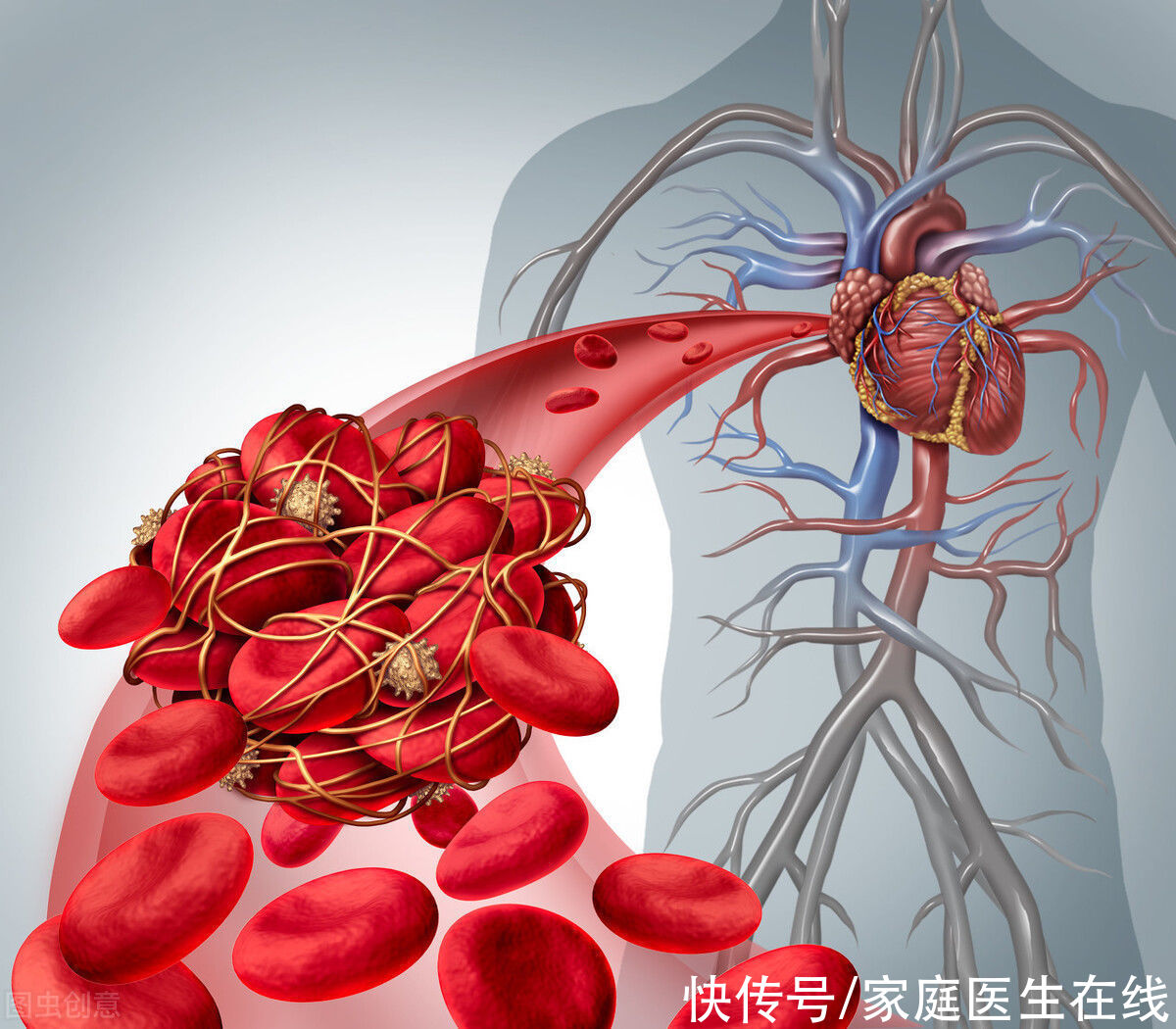  治疗|血栓堵塞血管很可怕？别担心，这5种治疗方法可帮助溶栓