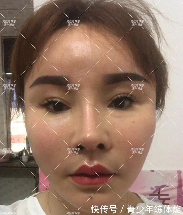 拉皮 小拉皮术后6个月,让她从老阿姨逆袭小姐姐!