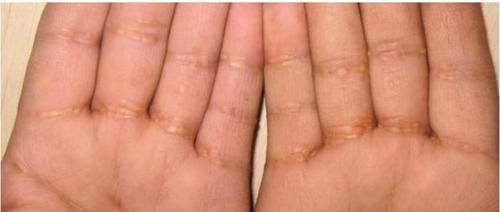 眼睛边出现这种小肉粒，多半是血脂高了，饭后坚持一件事稳定血脂