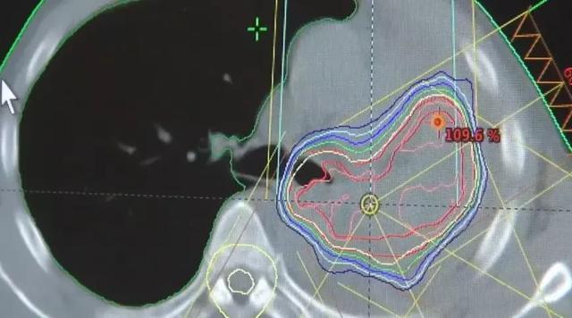 放疗|左肺被肿瘤堵死缩成一团，放疗后吐出一块“鱼肉”，肺瞬间充满