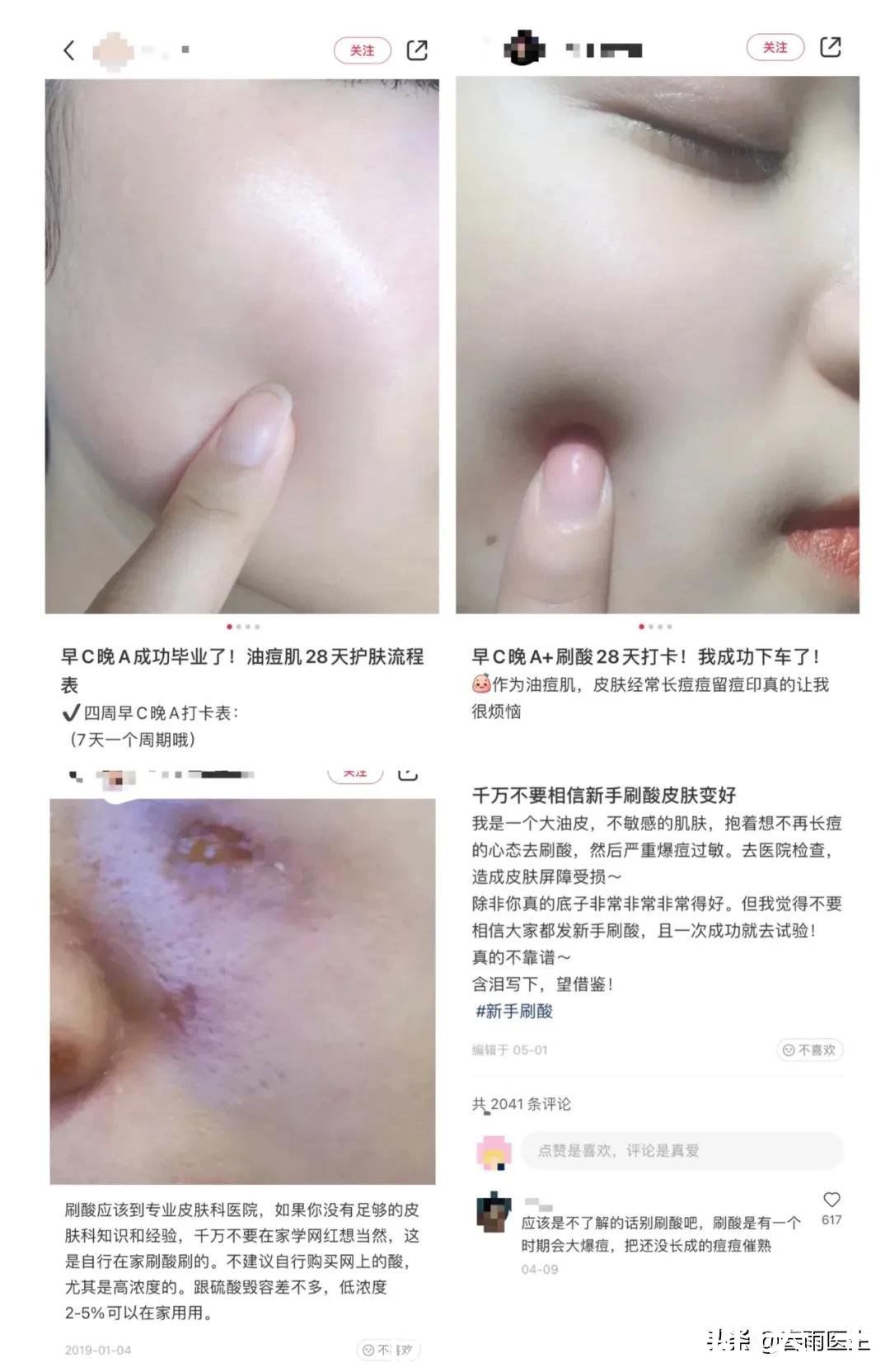 医疗|在家刷酸能刷出“妈生好皮肤”？当心脸烂到妈都认不出