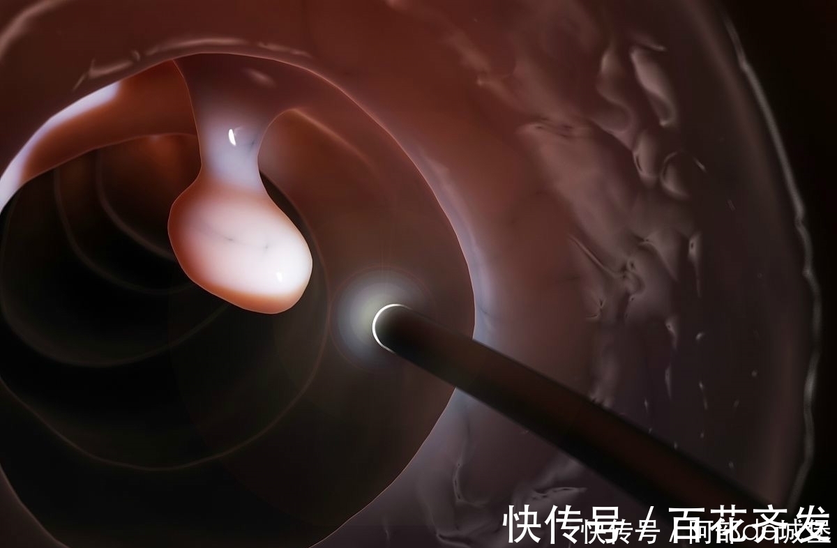 信号|患上大肠癌的第一个信号,常常是这种异常,最好去检查一下