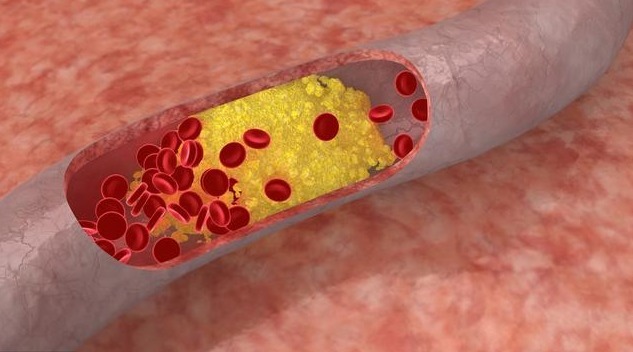 胆固醇|不想血管一年比一年堵，教你4个方法，靠饮食疏通血管