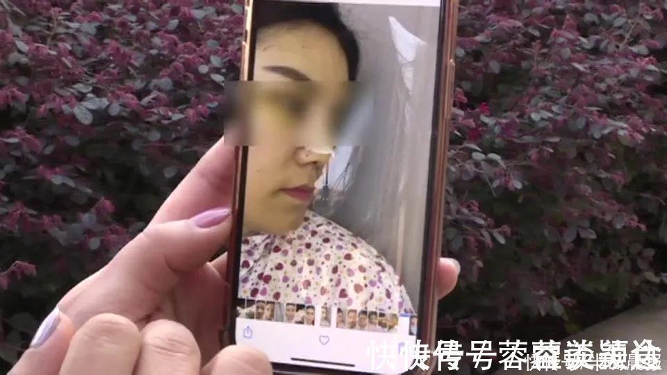 鼻子|花了近4万!女子取肋骨做的“欧美鼻”却变“妈生鼻”