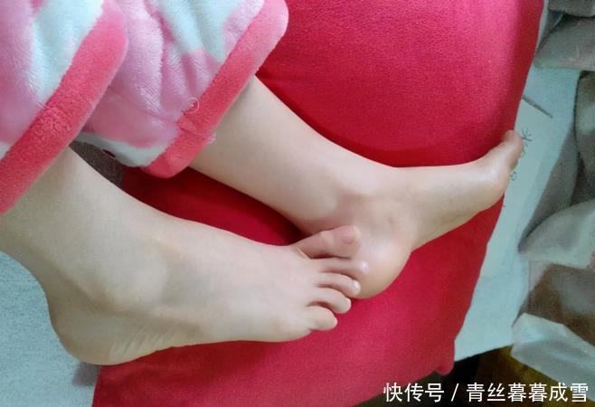 原因|为什么总是脚裂起硬皮2个原因莫忽视