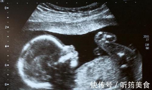 畸形儿|每次产检结果正常,孩子生出后发现畸形,医院需要负责吗?