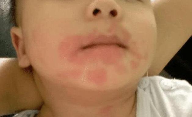 过敏|4种水果并不适合孩子吃,看似营养高,吃多了却是隐藏的危害