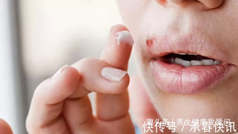 感染|2个月内3名幼童脑死亡！嘴角长这种水泡，真不是“上火”那么简单