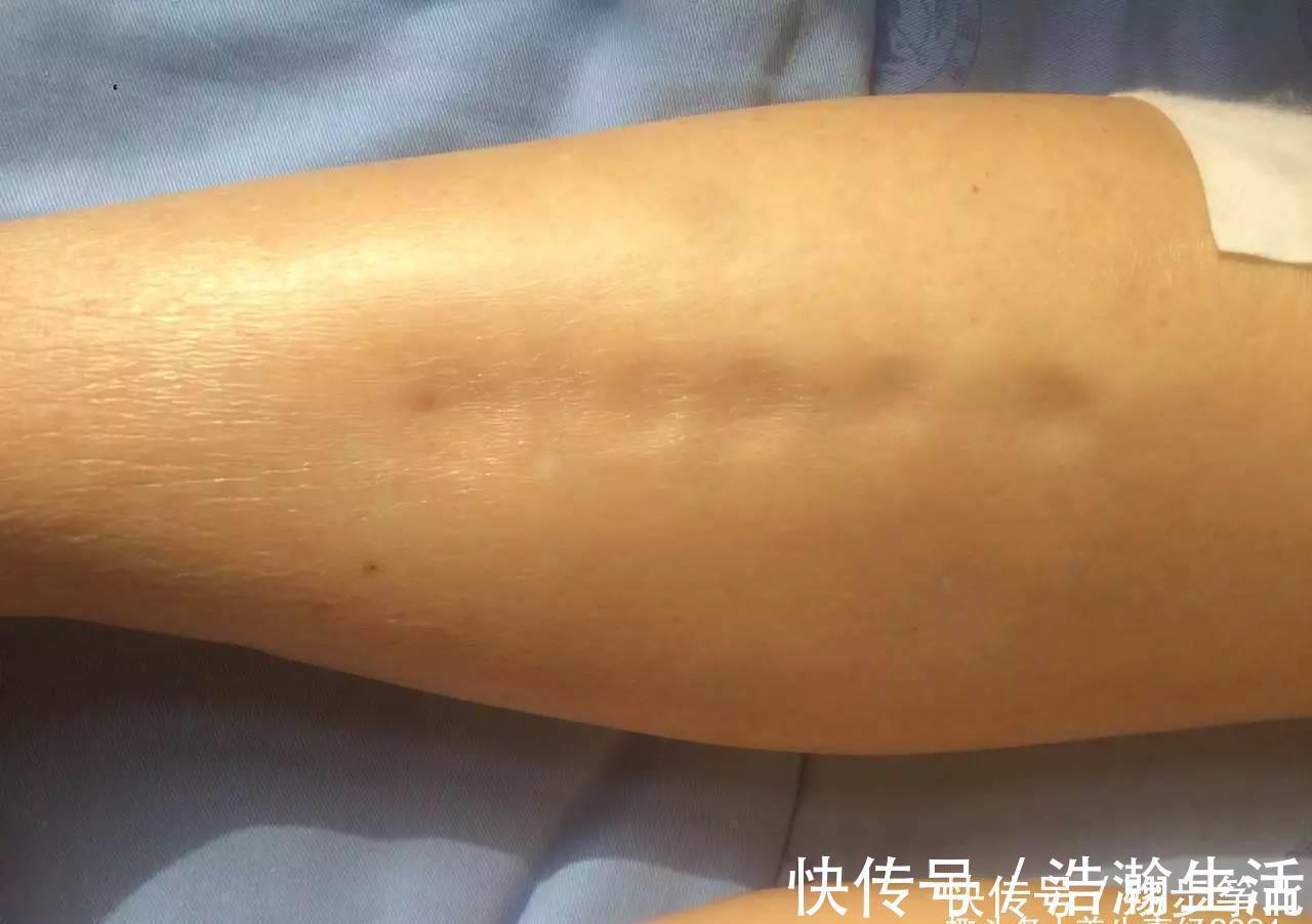 过敏性鼻炎|''熊猫眼''因为熬夜,还是肾虚?黑眼圈有三种类型,日常改善这么做