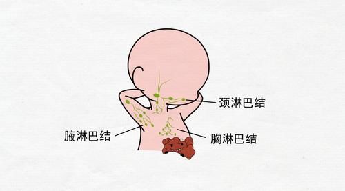 肺癌是如何转移的？