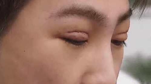 小傅|小伙为了变得更加帅气去割双眼皮,割完之后他的人生都发生了变化