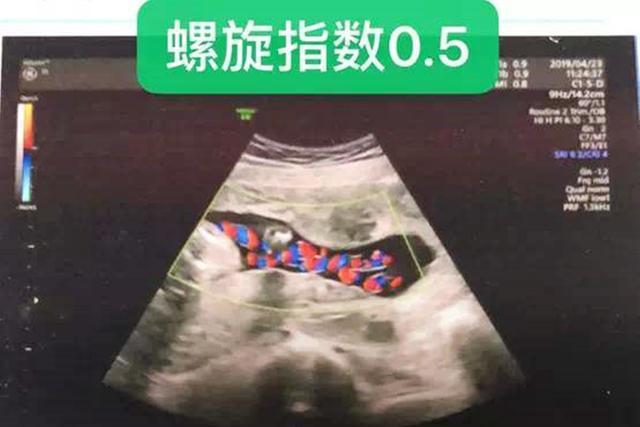 脐带|孕妈怀孕7个月脐带悄然断裂,很可能是“它”引起的,孕妈要注意