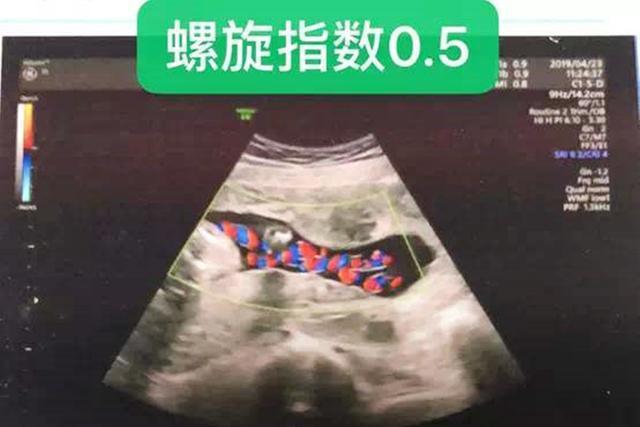 脐带|孕妈怀孕7个月脐带悄然断裂，很可能是“它”引起的，孕妈要注意