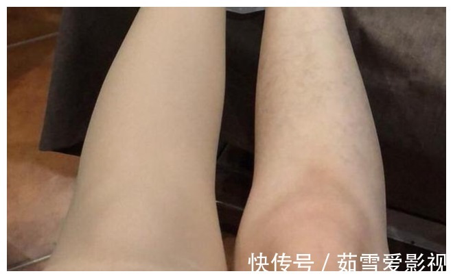 现象|双腿或是血脂的“晴雨表”？腿上出现这3种现象，血脂可能偏高了