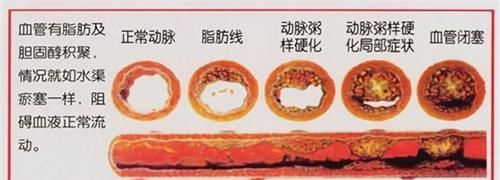 动脉|动脉硬化≠动脉粥样硬化,学好软化血管3个步骤,血流通畅少堵塞