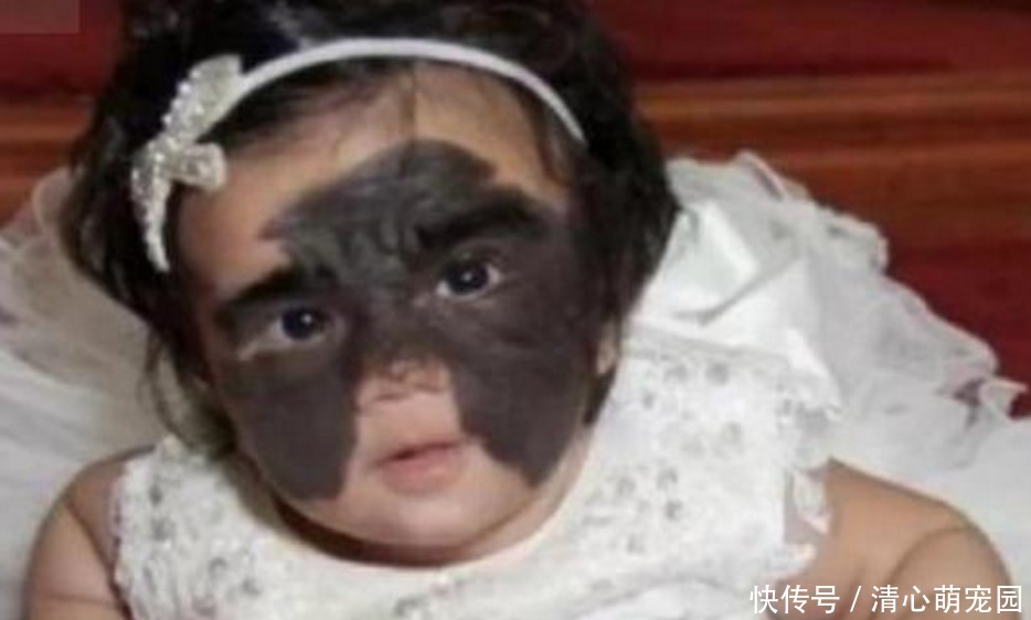 女婴一出生伴随“蝙蝠侠印记”,被父母送去整容7次,结果怎样了