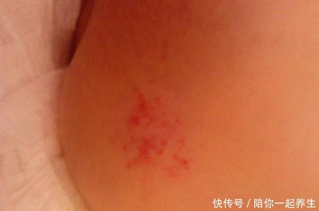 新生儿手臂生出“草莓斑”，宝妈以为碰了，医生检查后说要手术！