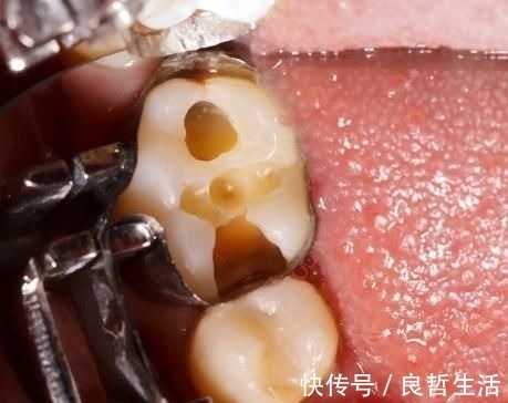 刷牙|10个5岁儿童中,7个有龋齿,罪魁祸首居然不是糖?