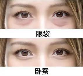 如何区分眼袋、泪沟、卧蚕？