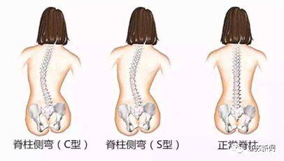 邱勇|孩子背部突出没在意，结果拖到要动手术！这种病无法预防只能靠……