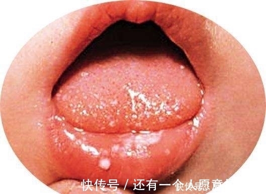 心火|心火过旺的5个表现，多吃4种食物，不失眠、不便秘、睡得香